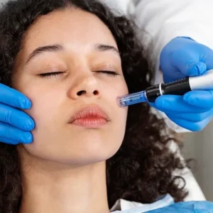 Tratamiento smart peel